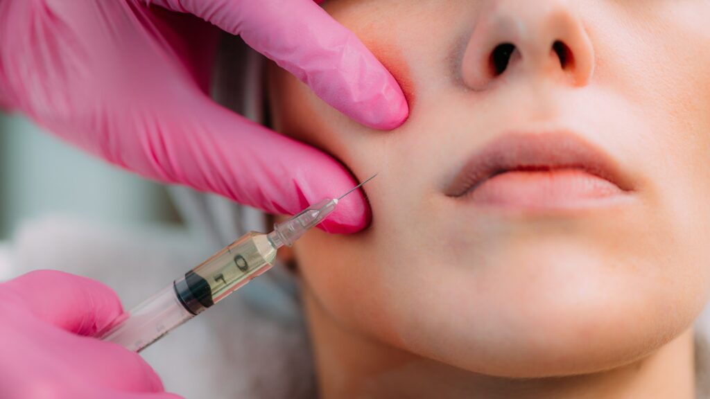 Dermal Filler Injection for Cheeks