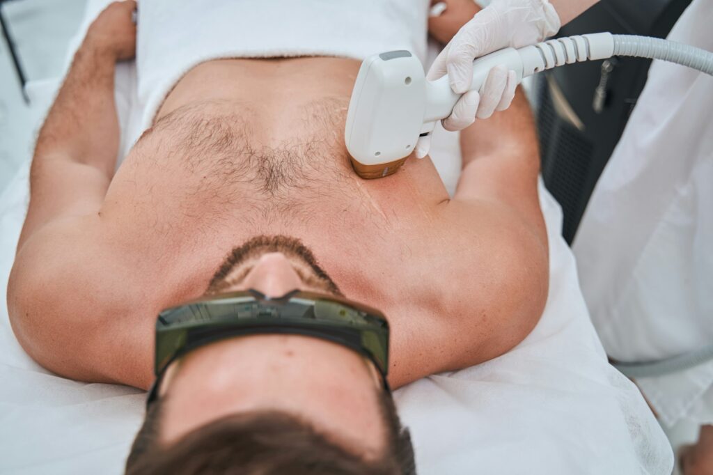 Laser Hair Removal for Men: Everything You Need to Know